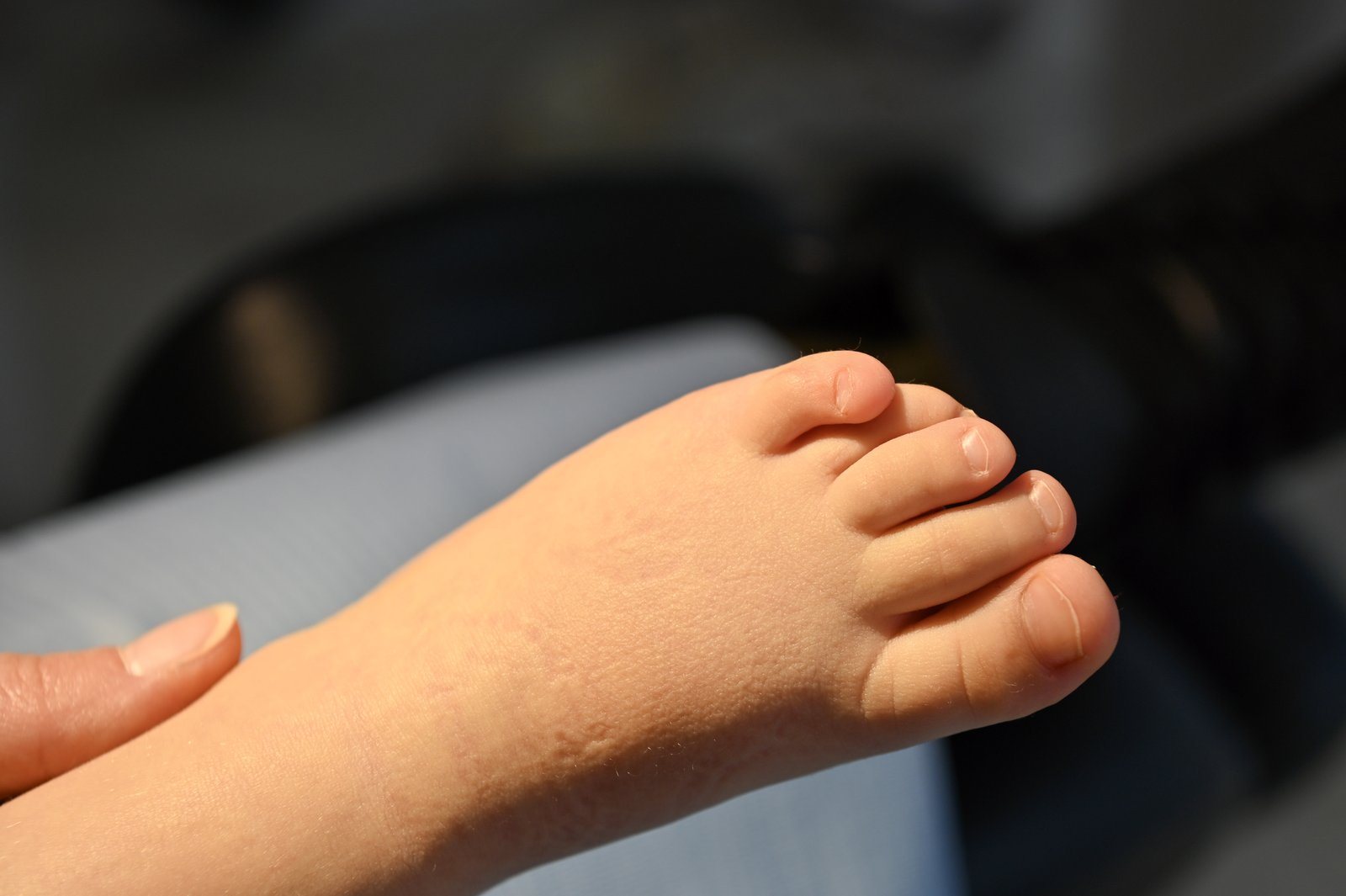 Orthoplastie à La Clinique du Pied