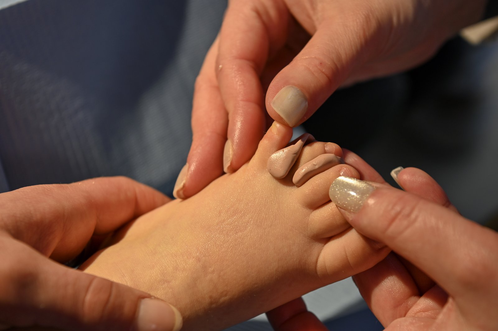 Orthoplastie à La Clinique du Pied
